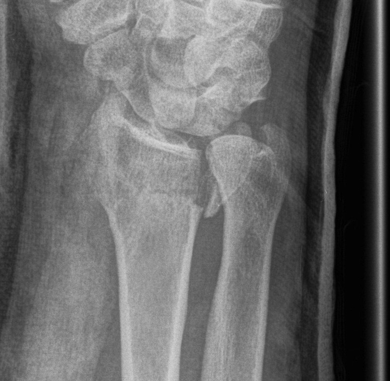 Distal Radius Fracture DRUJ incongruent